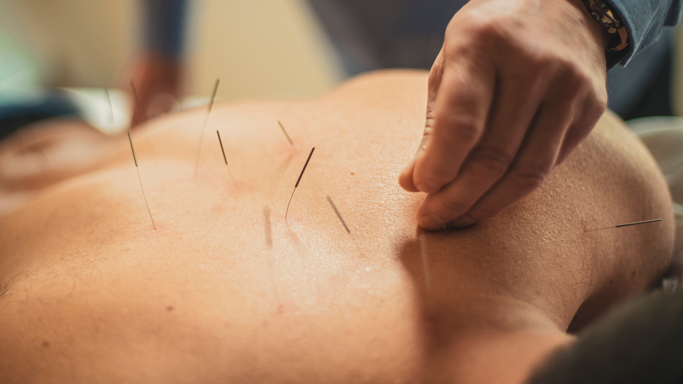 Photo d'un dos surlequel un acupuncteur est en train de positionner des aiguilles. 